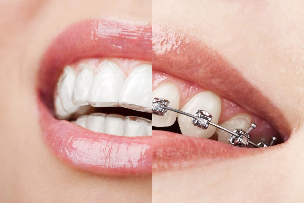 What is Invisalign and what are the benefits? BLVD Dentistry & Orthodontics,  AZ