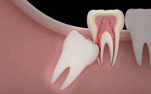 A Guide to Avoid Dry Socket after Wisdom Teeth Removal - Wisdom